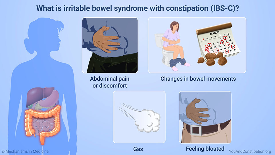 What is IBS-C?
