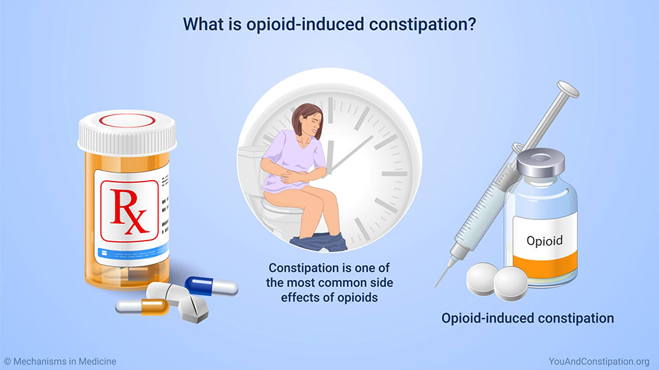 What is opioid-induced constipation?
