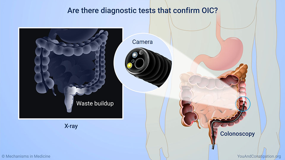 Are there diagnostic tests that confirm OIC?