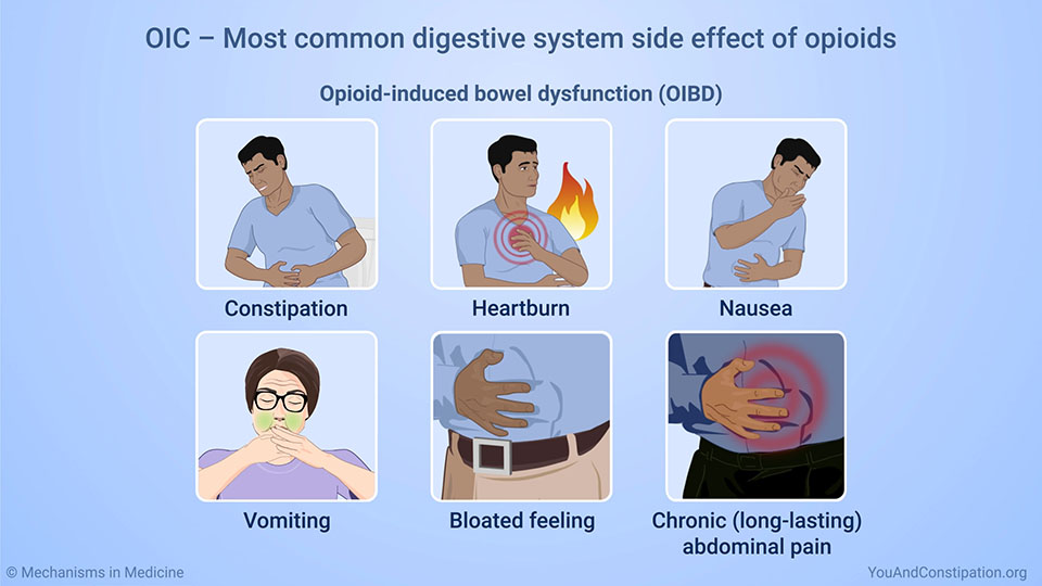 OIC – Most common digestive system side effect of opioids