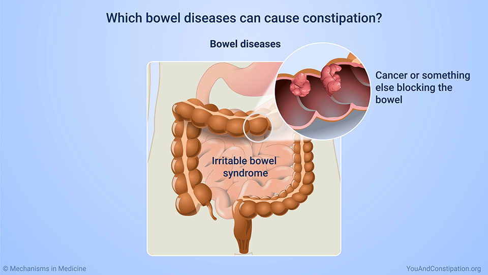 Which bowel diseases can cause constipation?