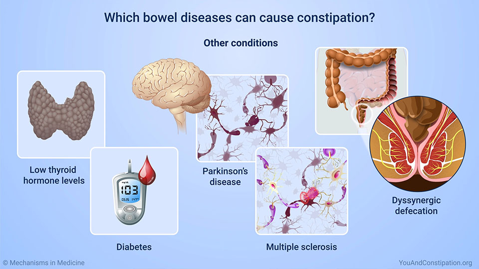 does constipation cause hyperactive bowel sounds