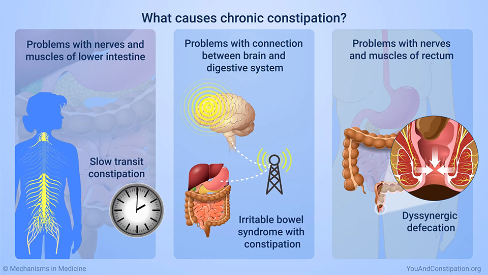 What causes chronic constipation?
