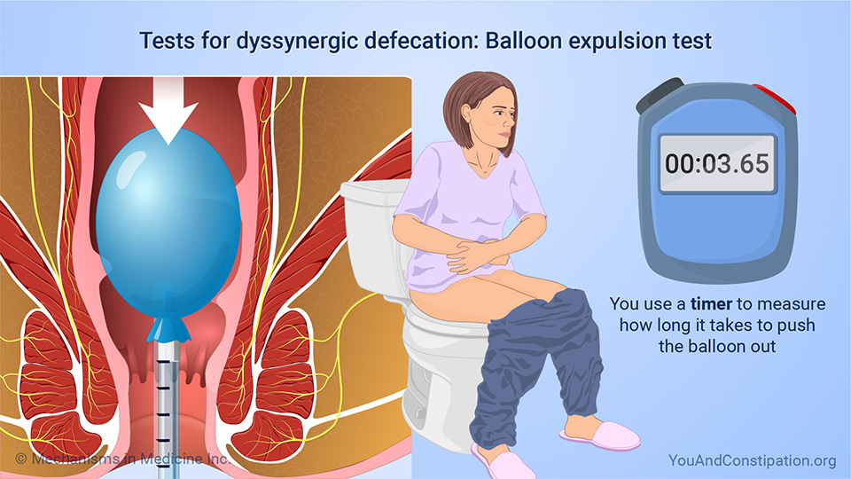 Slide Show Understanding Dyssynergic Defecation