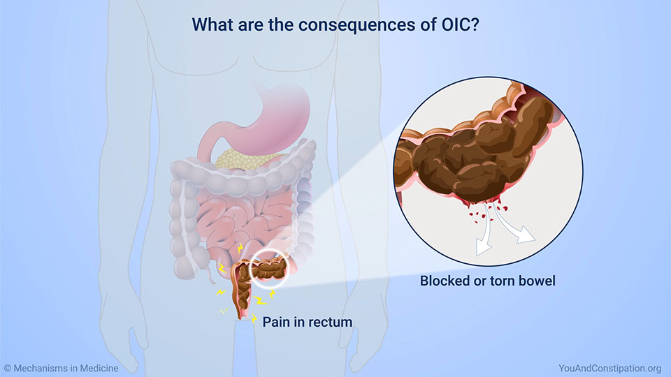 What are the consequences of OIC?